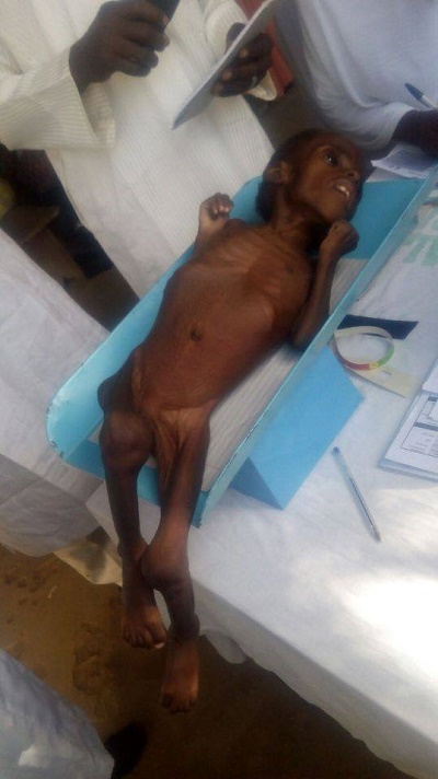 See Photos of a Starving and Malnourished 2-year-old Child From Gombe State 1