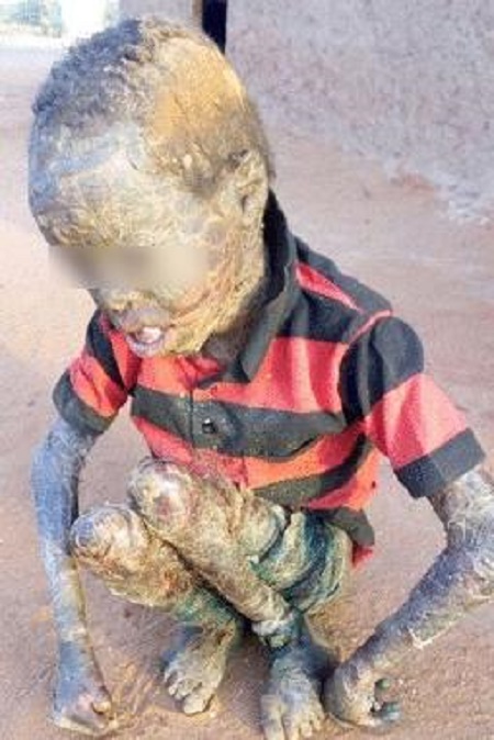 Omg! See How These Children Look After Contracting Rare ...