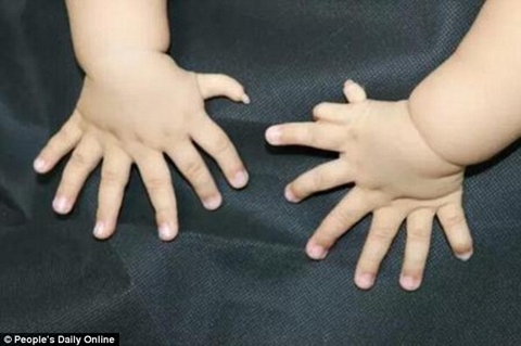 baby-born-with-15fingers-1.jpg
