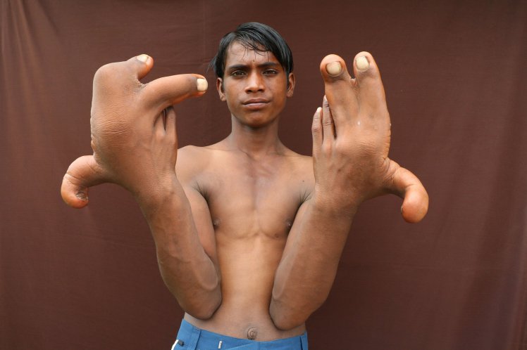 Cryptic: See the Boy Who Was Dubbed 'The Devil' After Being Born With Giant Hands (See Photos)