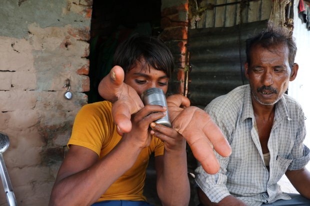 Inde : un garçon de 12 ans né avec des mains géantes surnommé « diable » par les villageois (photos)