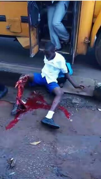 Heartbreaking: Student's Leg Crushed in Lagos On His Way to School