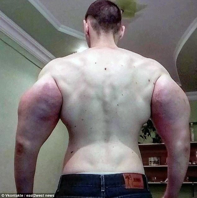 Russian 'Popeye' has 3 pounds of 'dead' muscle removed after DIY  bodybuilding injections