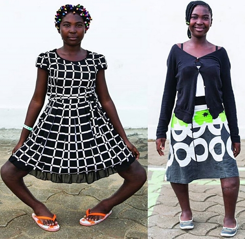 Am Happy To See My Feet Straighten Than Before – 14 Year Old Girl