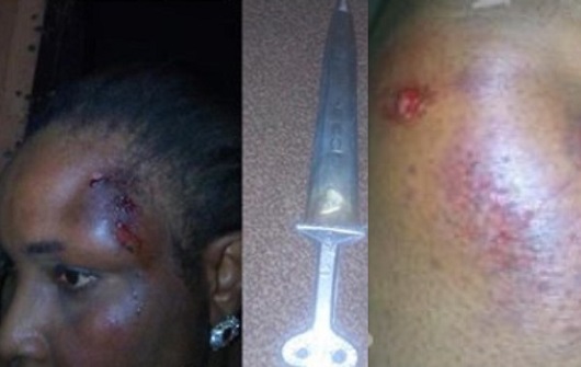 Linda Akudo Nwachukwushows off injuries from her ordeal