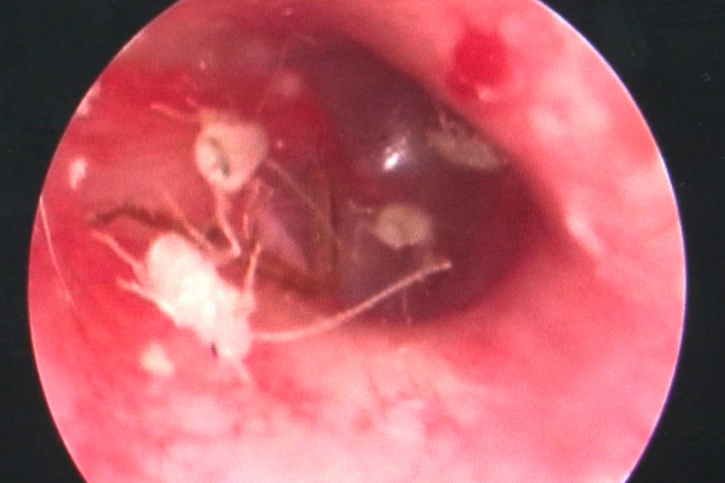 cockroaches in man's ear