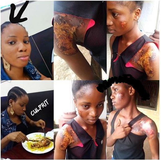 AAU student scalded