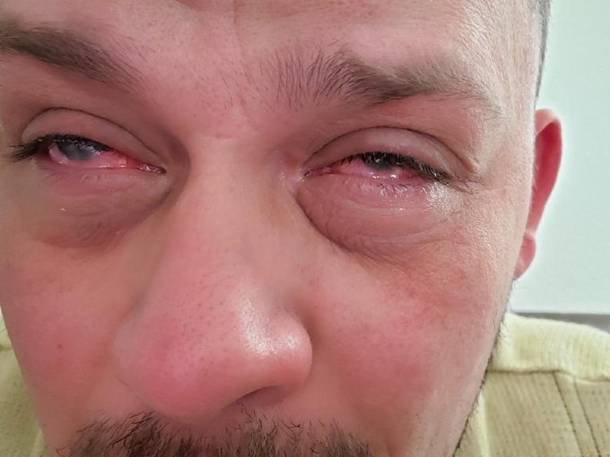 The man became blind after contracting mutated coronavirus