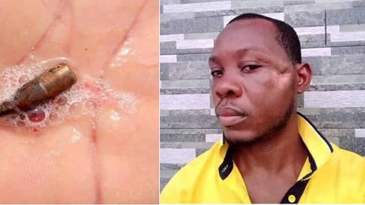The man vomited stray bullet lodged in his head for months