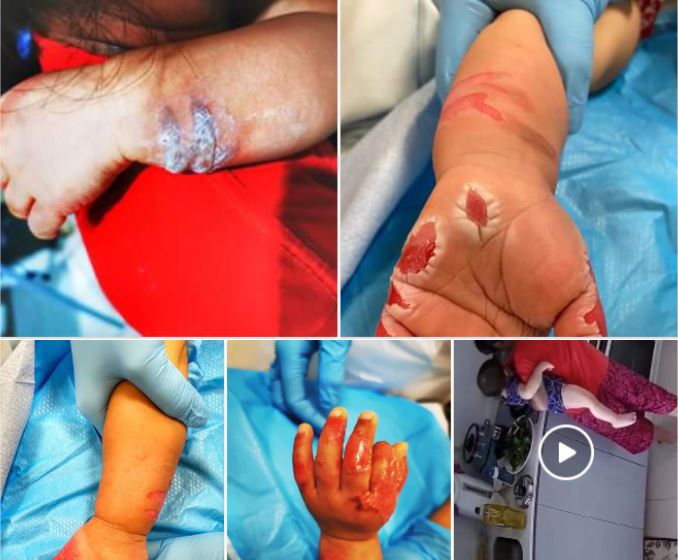 The toddler's hands burnt