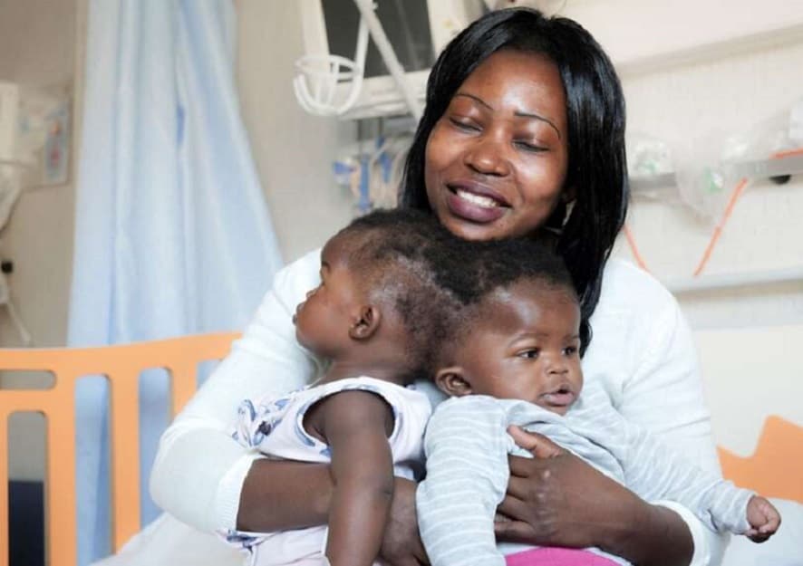 Ervina and Prefina have been successfully separated by doctors