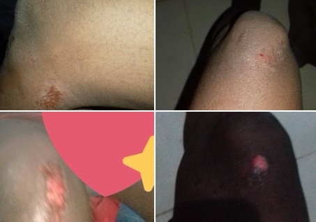 bruises