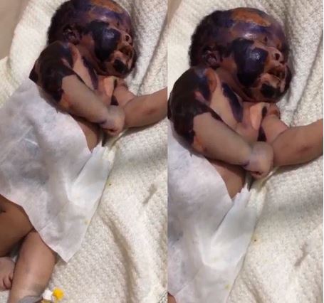 Newborn baby burnt
