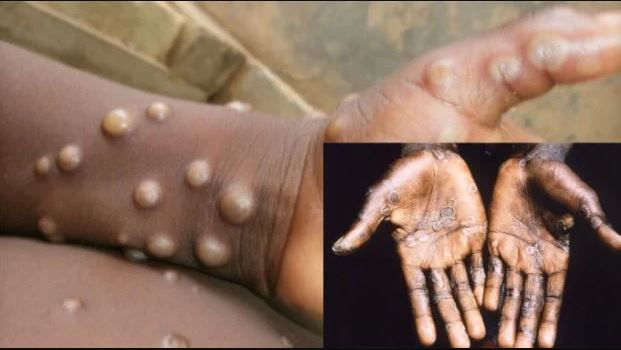 Monkeypox