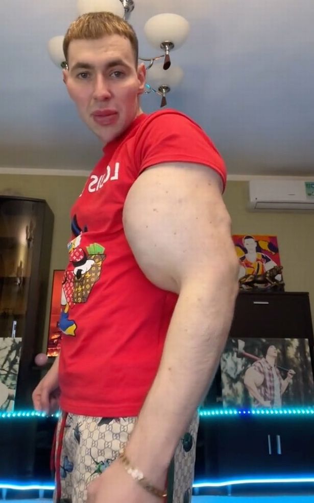 Meet The Bodybuilder Who Injected Oil Into Biceps To Make Them Big (Photos)