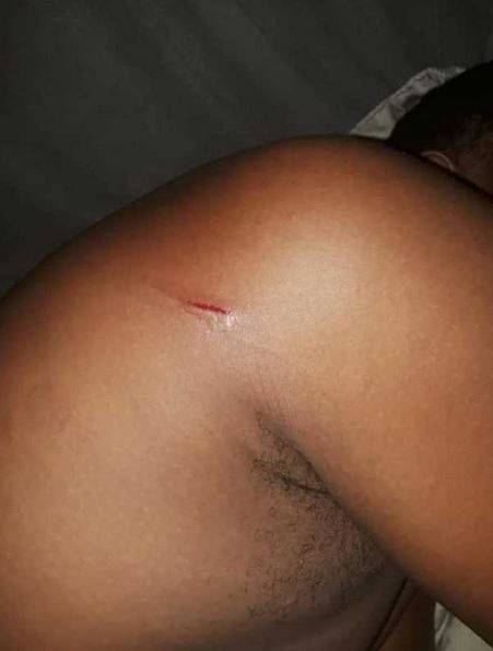 scar