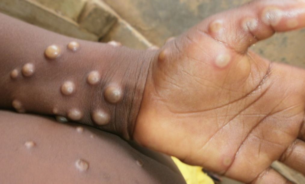 Monkey Pox