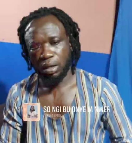 Musician Brutalised By APC Thugs, Risks Losing One Eye For Refusing To Compose Song For Campaign In Ebonyi