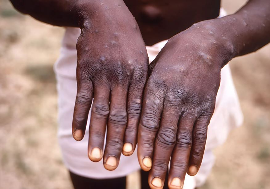 Mpox