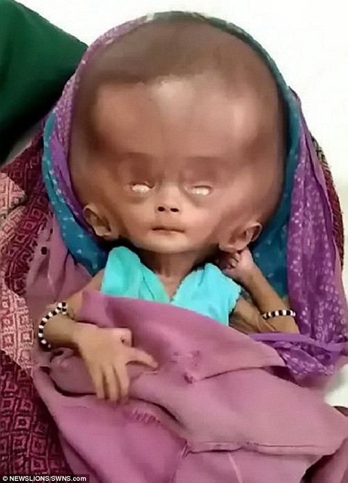 Little Baby with Head as Big as Watermelon Baffle Doctors in India (See