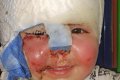 2-year-old Boy Left Almost Blinded After Being Scalded by Hot Oil While His Mother Was Cooking 