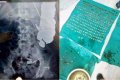Unbelievable: Medical Doctors in Shock as They Remove 263 Coins from a Man