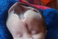 The Miracle Child: Meet The Baby Girl Who Was Born With Half Her Skull Missing (Photos)