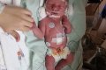 Unbelievable: See The Baby Who Was Born Not Breathing After Suffering Stroke While Still In The Womb