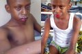 Red-blooded Eyes, Bleeding Lips & More: Boy Almost Died After Horrible Reaction To Juice Drink (Graphic Photos)