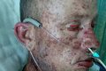 Graphic Photos: Man Goes Blind After Taking Antibiotics To Cure Staph Infection
