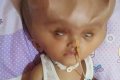 Heartbreaking! Baby Battling Rare Brain Condition Left With 