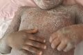 Shock As Little Boy Suffers Bizarre Adverse Drug Reaction On Skin After Taking Malaria Drug In Abuja (Photos)