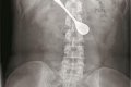 Horror! Woman Swallows 5-Inch Spoon While Trying To Use It To Remove Bone From Her Throat