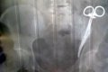 Unbelievable Story Of Woman Who Had A Surgical Clamp Lodged Inside Her Abdomen For 23 Years