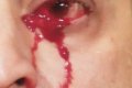 Family In Deep Shock As 52-year-old Man Starts Crying Bloody Tears Spontaneously 