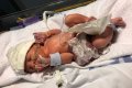 Sad Story Of 2-year-old Boy Who Was Born With His Internal Organs Outside His Body (Photos) 