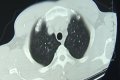Unbelievable! Over 700 Tapeworms Found Inside Man