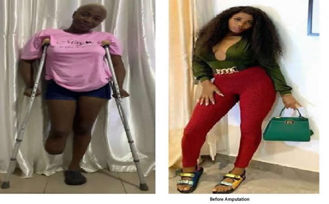 I Begged Doctor To Amputate My Leg Because Of Severe Pain — Ibadan Poly Graduate Tells Her Story