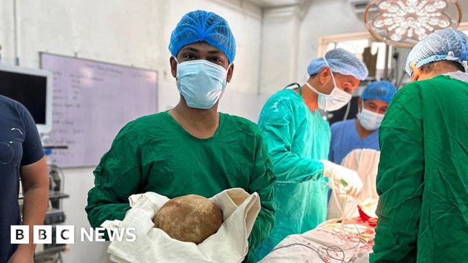 Doctors Remove Giant Bladder Stone Bigger Than a Newborn Baby Image